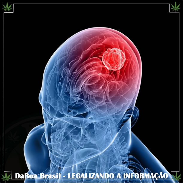 CBD pode melhorar o tratamento no glioblastoma multiforme (tumor cerebral)